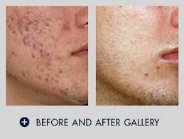 laser acne treatment vbeam