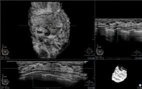 They may also feel firm or solid, and might simple imaging techniques, such as a mammogram or breast ultrasound, can usually provide reassurance. Breast Ultrasound What S New For 2013 Imaging Technology News