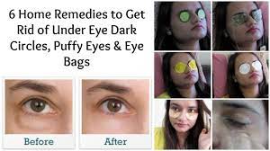 puffy eyes eye bags