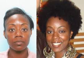 A hair transplant can seem like a big decision for something that often just a i am delighted with my new hair growth and i am much more confident. African American Female Hair Transplant Testimonial Carolina Hair Surgery Charlotte Nc Charleston Sc