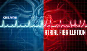 the afib t how to prevent afib
