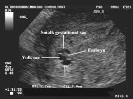 Abnormalities In The Size Of The Gestational Sac