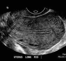 Endometrial Thickness Radiology Reference Article