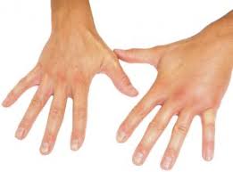 swollen hands in the morning caused by