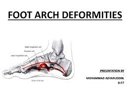Problems with the arch of the foot can also cause pain in different parts of the body, including the ankle, heel, legs, knee, and back. Foot Arch Deformities 2