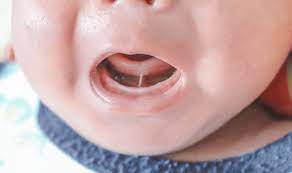 how does tongue tie affect your child s