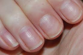 10 fingernail issues and what they mean