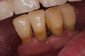The splint usually covers most of the teeth present in the dental. Dentapreg Dentapreg
