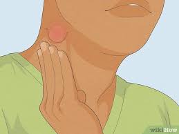 how to reduce lymph node swelling 3