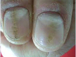 nail diseases an ciform