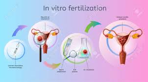 In Vitro Fertilization Process Realistic Vector Chart With Ivf