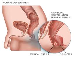 6 diffe ways to treat fistula