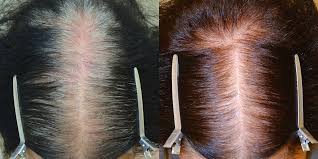 spironolactone hair restoration of