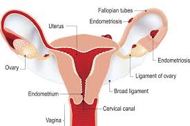 Endometriosis synonyms, endometriosis pronunciation, endometriosis translation, english dictionary definition of endometriosis. What Is Endometriosis Posts Facebook