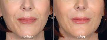 restylane in madison ct lip fillers