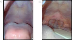 occult submucous cleft palate