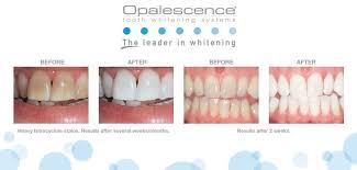 cosmetic dentistry tooth whitening