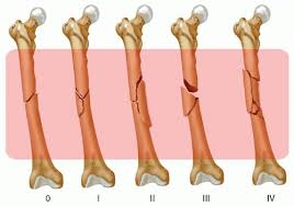 retrograde intramedullary nailing of