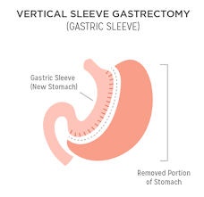 gastric sleeve surgery vs mini gastric