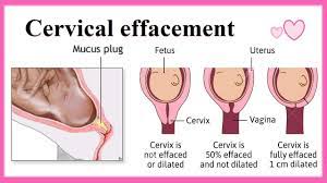 cervical effacement you