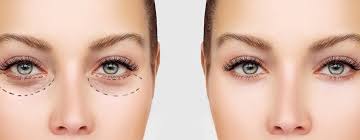 eyelid surgery procedure care after