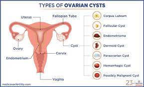 ovarian cyst it s symptoms diagnosis