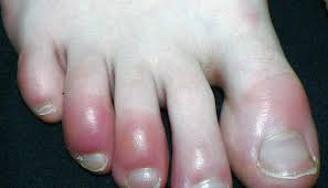 what causes redness around the toenail