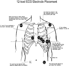 placement of 12 lead ecg electrodes ra