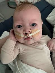 photo of their baby with cleft lip