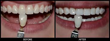 teeth whitening in tri cities wa
