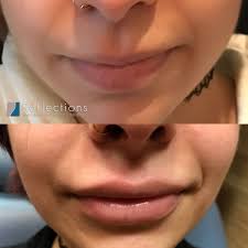 juvederm lip filler results