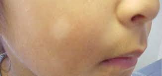 pityriasis alba white spots on face