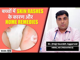 baby skin rash causes home remes