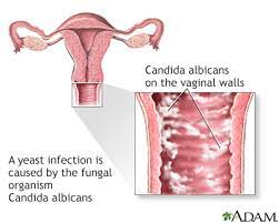 inal yeast infection information