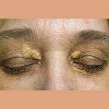 surgical removal of warts xanthelasma