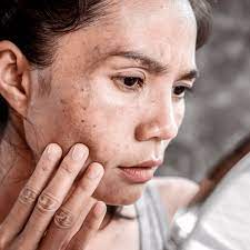 how to get rid of dark spots on your