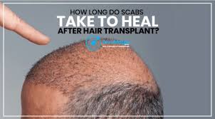 heal after hair transplant