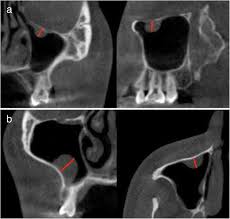 mucous retention cysts