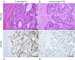 Estadiamento da drc segundo a iris. Frontiers Proposal For A Histological Staging System Of Mammary Carcinomas In Dogs And Cats Part 2 Feline Mammary Carcinomas Veterinary Science