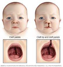 cleft lip and cleft palate disease