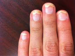 onycholysis nail separation