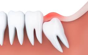 wisdom teeth removal tooth extraction