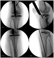 a review of proximal tibia entry points