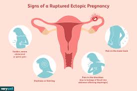 ruptured ectopic pregnancy signs