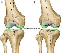 Total Knee Arthroplasty Springerlink