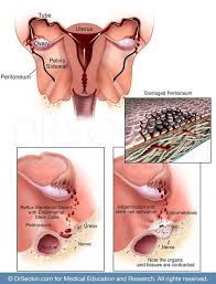 Maybe you would like to learn more about one of these? Endometriosis Symptoms Causes And Treatments Drseckin Com