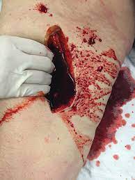 For a rifle round, the round impacts the person and tears a gigantic wound cavity behind it's point of entry, tearing away a huge exit hole or outright . Wound Packing Essentials For Emts And Paramedics Jems
