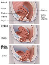 uterine and bladder prolapse guide