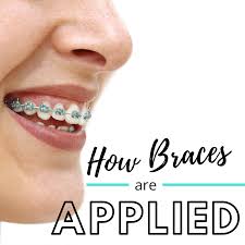 To learn more about how to best clean your teeth with braces and what to expect during orthodontic treatment. How Braces Are Applied