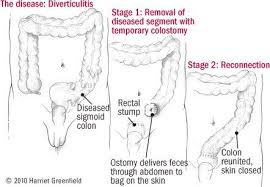 diverticulosis and diverticulitis guide